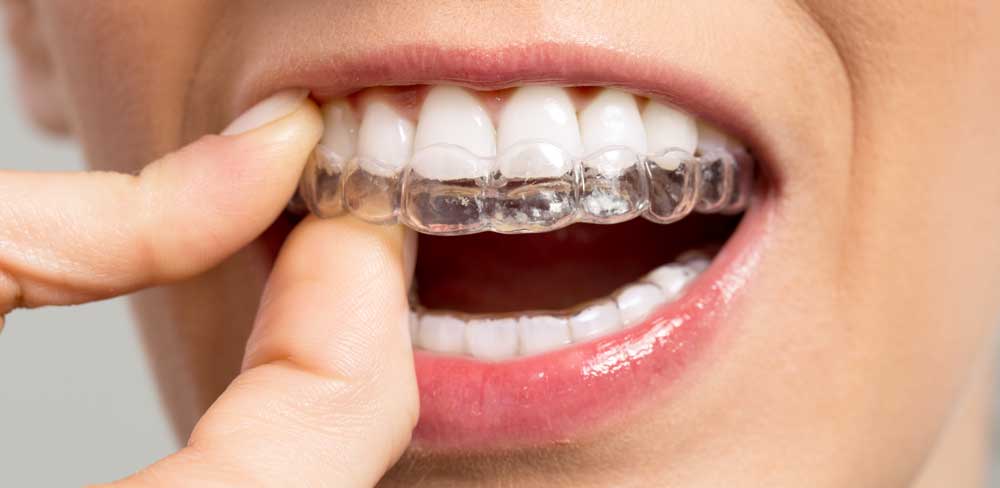 Como funciona Invisalign Como funciona Invisalign