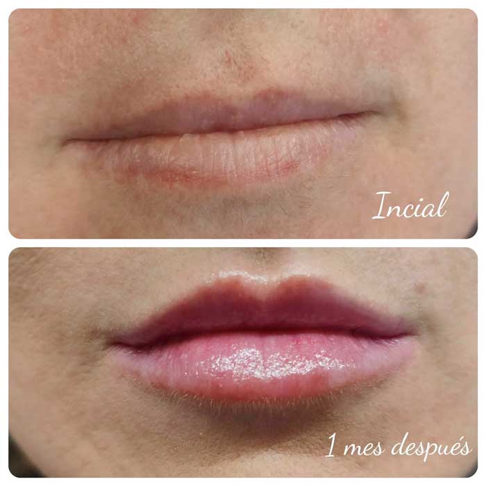 Labios-hialuronico-con-1-mes-de-control