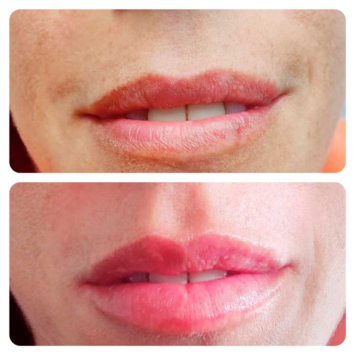 Tami-hialuronico-antes---despues