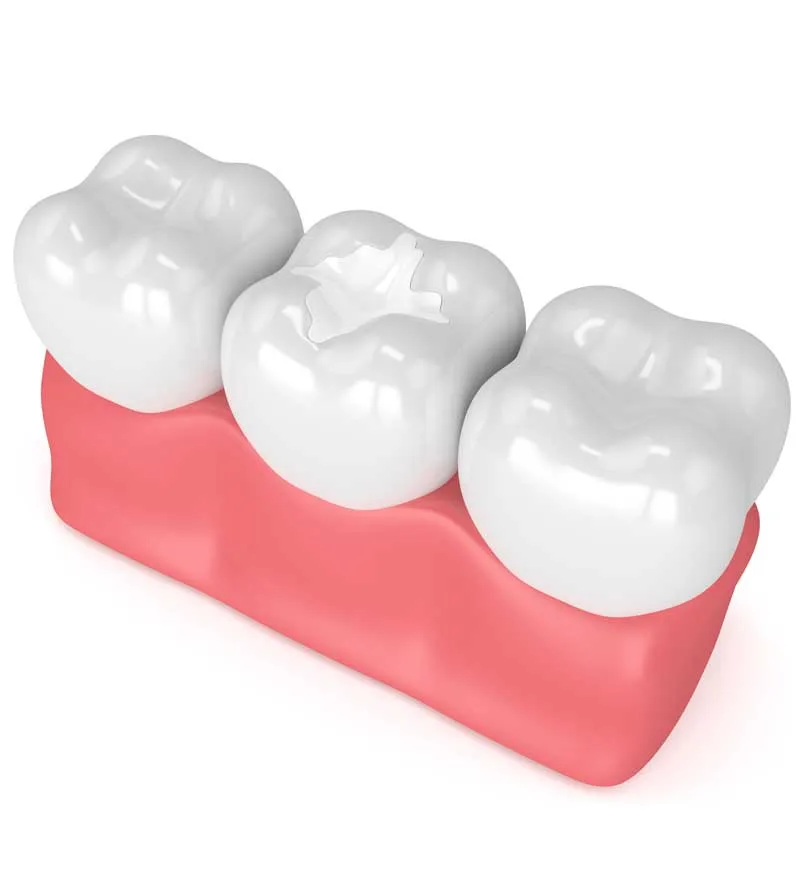 Incrustaciones dentales - Empastes