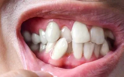 Los dientes supernumerarios y sus efectos dentales