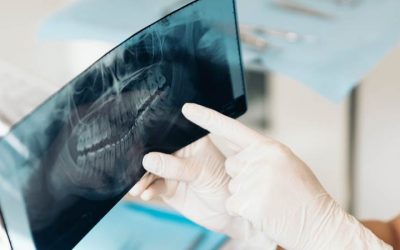 Los injertos óseos en odontología, ¿Cuáles son las principales innovaciones?