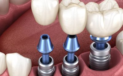 Proceso de colocación de implantes dentales: Lo que los pacientes deben saber